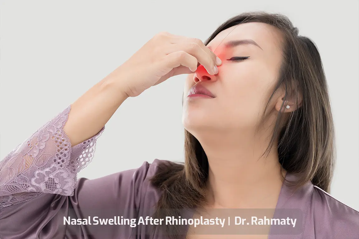 تورم بینی بعد از رینوپلاستی تصویر - Nasal Swelling After Rhinoplasty pic