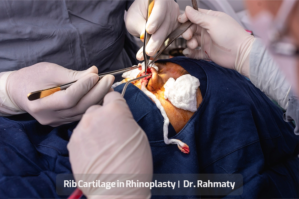 غضروف دنده تصویر - Rib Cartilage in Rhinoplasty - غضروف الضلع في جراحة الأنف
