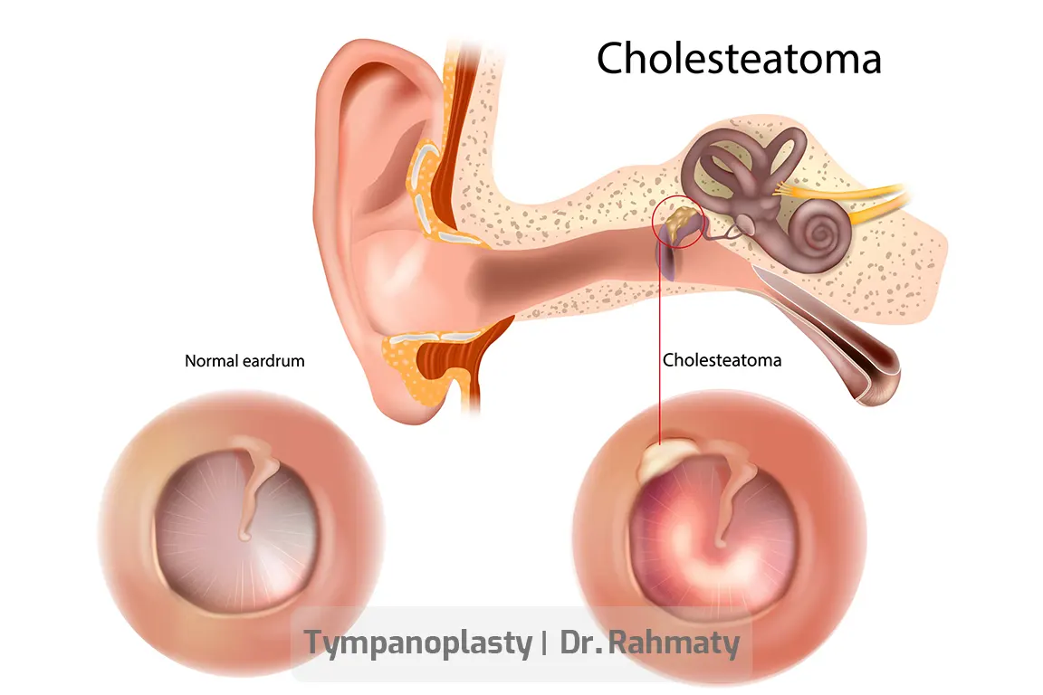 تمپانوپلاستی 2 - tympanoplasty 2 - رأب الطبلة 2
