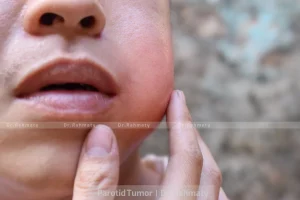 تومور پاروتید ۱ - parotid tumor 1 - ورم الغدة النكفية 1