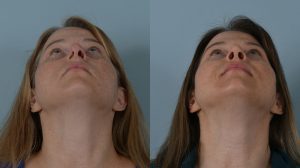 عمل بینی و رینوپلاستی تصویر 1 | nose surgery pic 1