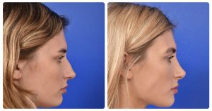 مراقبت های بعد از عمل بینی تصویر 1 - post-operative care after rhinoplasty pic 1
