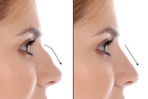 عمل بینی و رینوپلاستی تصویر 2 | nose surgery pic 2