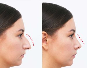 مراقبت های بعد از عمل بینی تصویر 3 - post-operative care after rhinoplasty pic 3