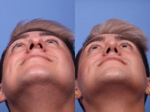 عمل بینی و رینوپلاستی تصویر 4 | nose surgery pic 4