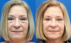 جراحی پلک تصویر 1 - Eyelid Surgery pic 1