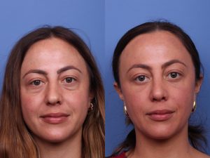 جراحی پلک تصویر 2 - Eyelid Surgery pic 2