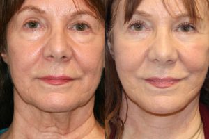 جراحی پلک تصویر 3 - Eyelid Surgery pic 3