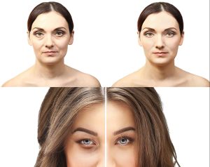 جراحی پلک تصویر 4 - Eyelid Surgery pic 4