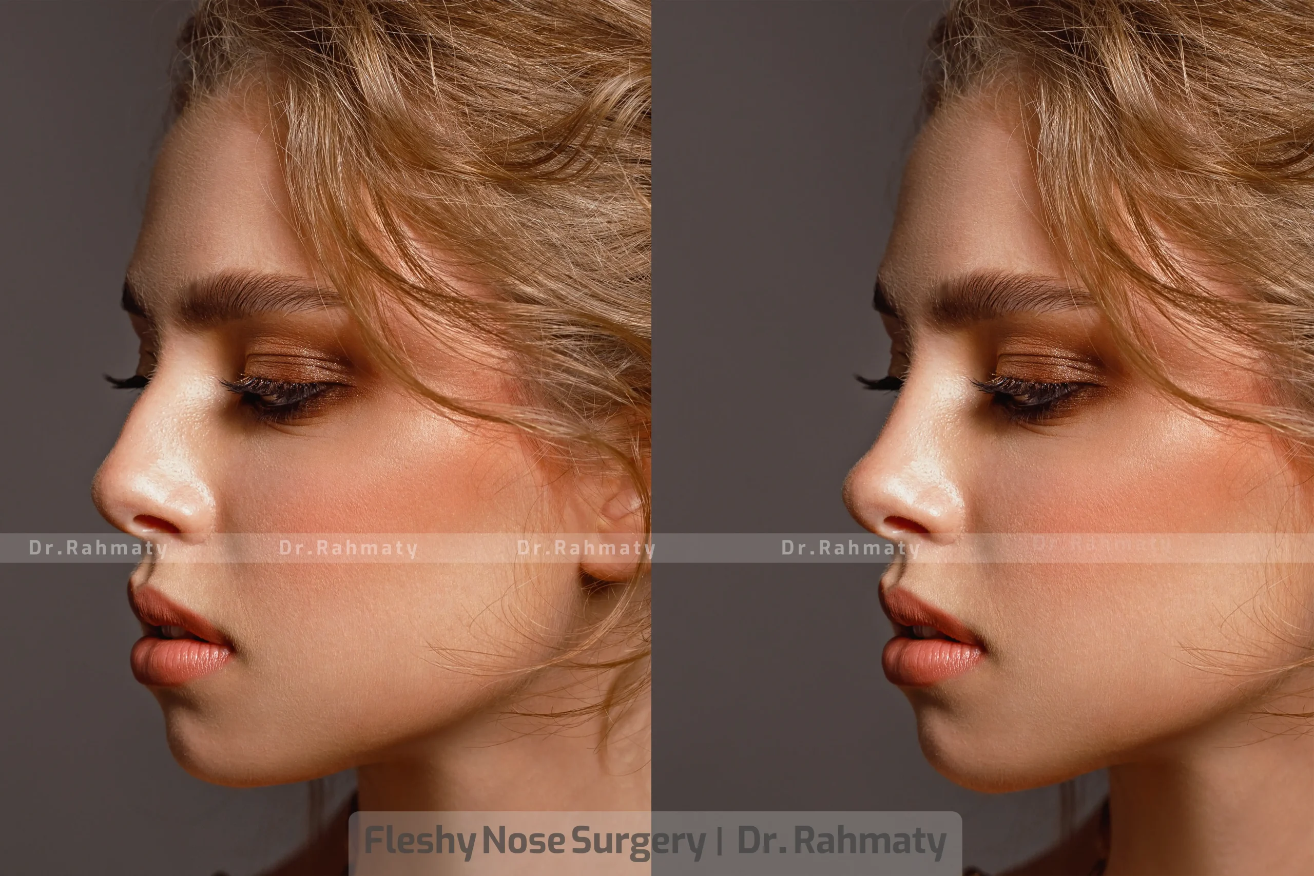 عمل بینی گوشتی تصویر 2 - Fatty nose surgery pic 2