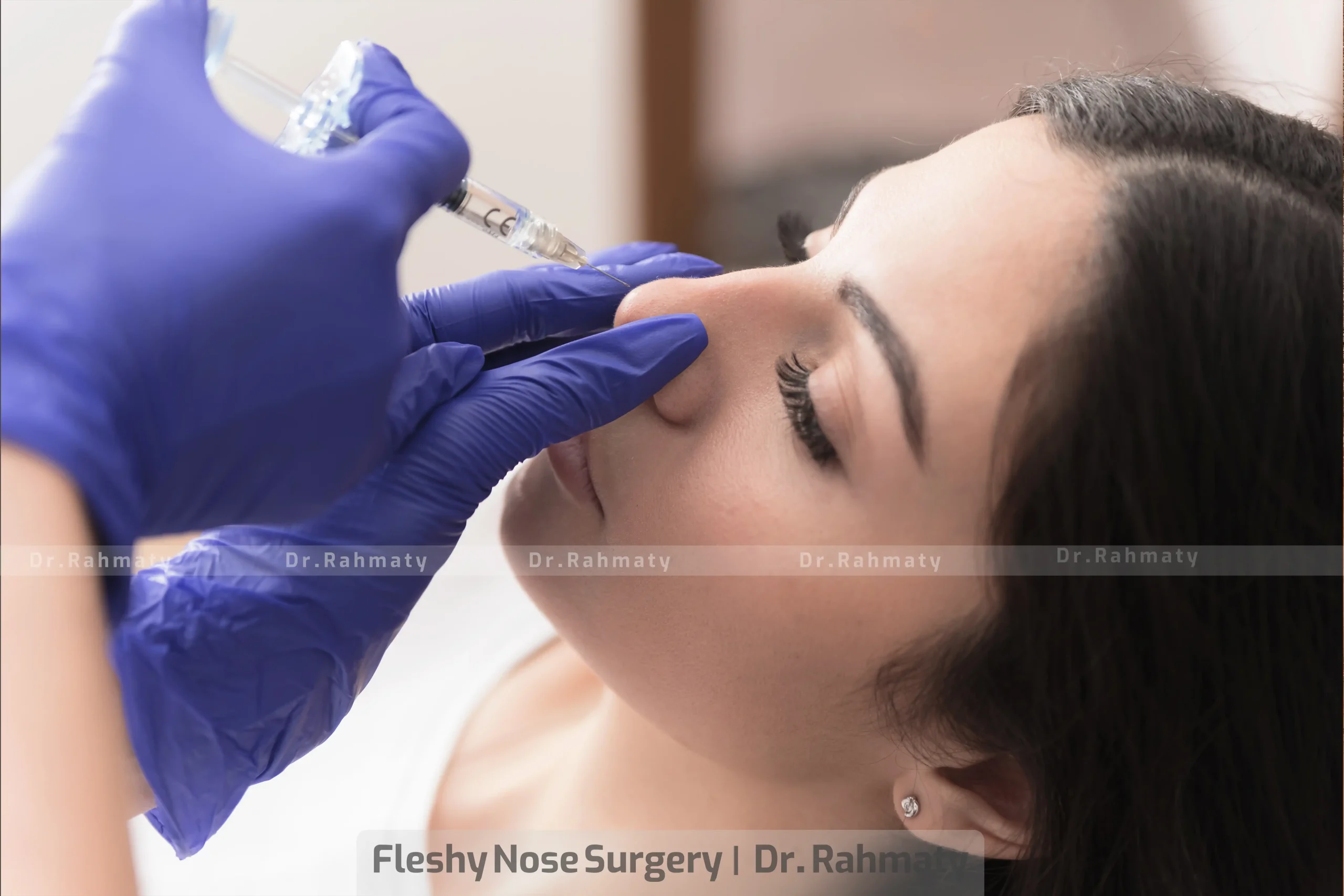 عمل بینی گوشتی تصویر 3 - Fatty nose surgery pic 3