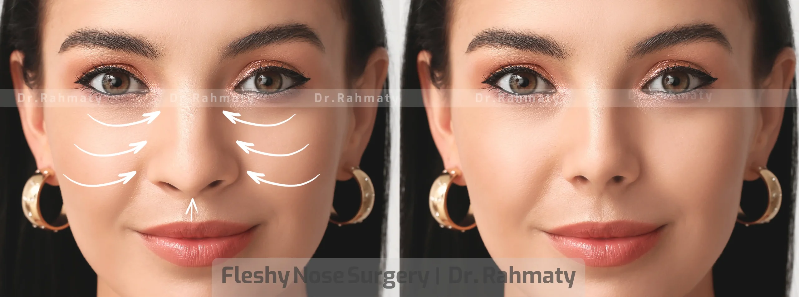 عمل بینی گوشتی تصویر 4 - Fatty nose surgery pic 4