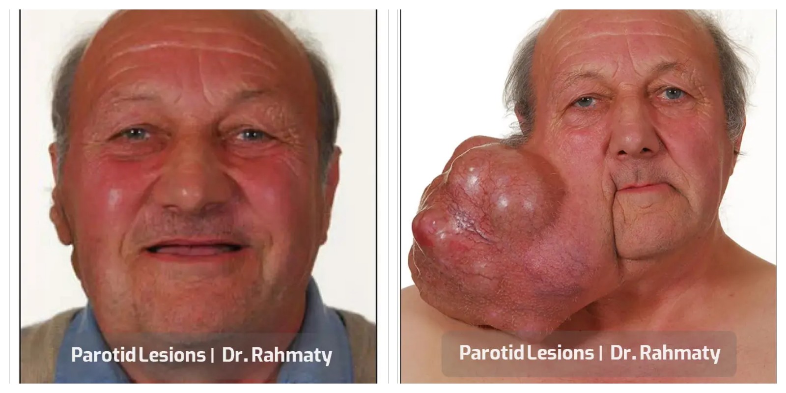 ضایعات پاروتید تصویر قبل و بعد - Parotid Lesions pic before after