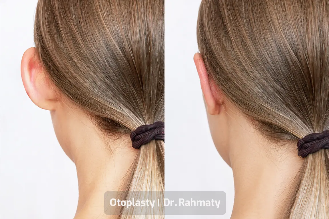 جراحی زیبایی گوش تصویر- Otoplasty pic