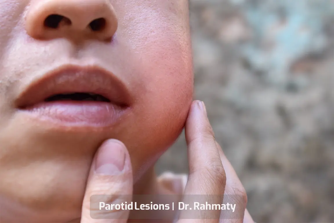 ضایعه پاروتید کاور- Parotid Lesions cov