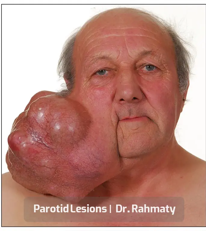 ضایعه پاروتید تصویر1- Parotid Lesions pic1