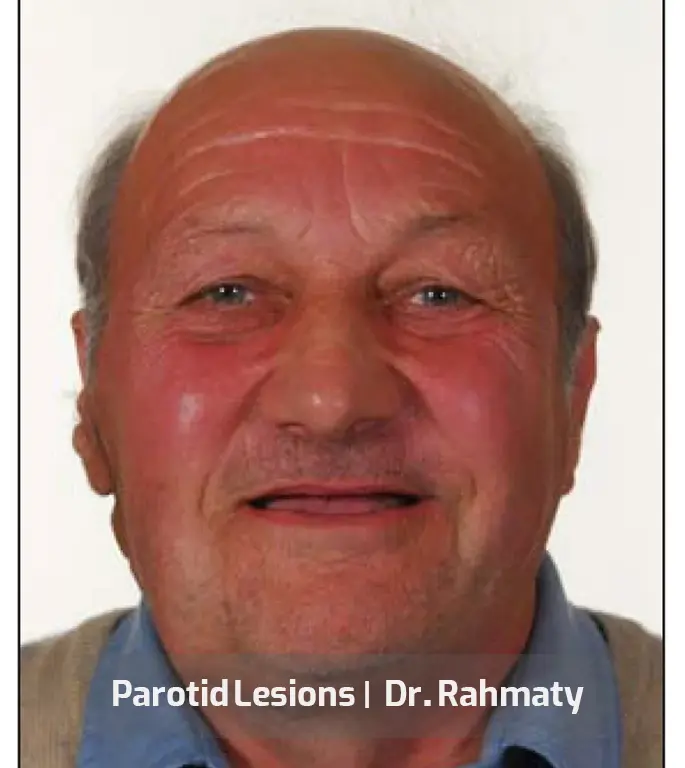 ضایعه پاروتید تصویر2- Parotid Lesions pic2