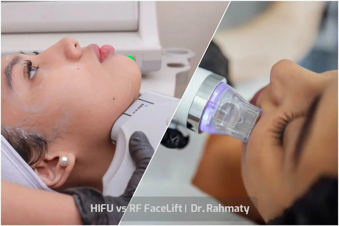 HIFU vs RF Facelift