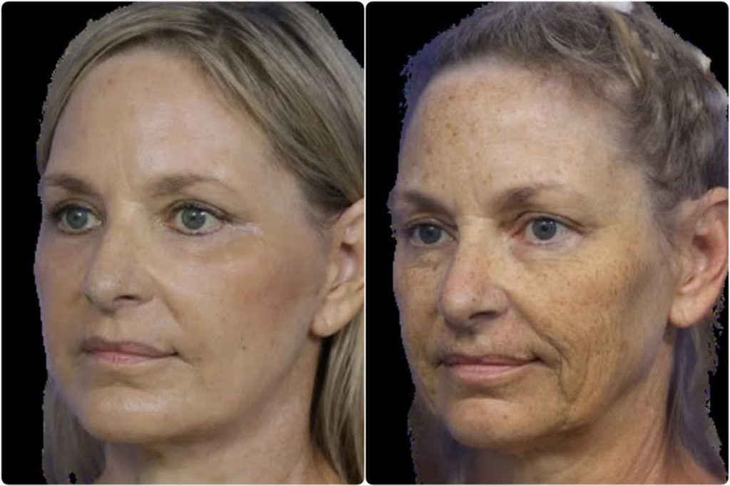 قبل و بعد لیفت صورت 2