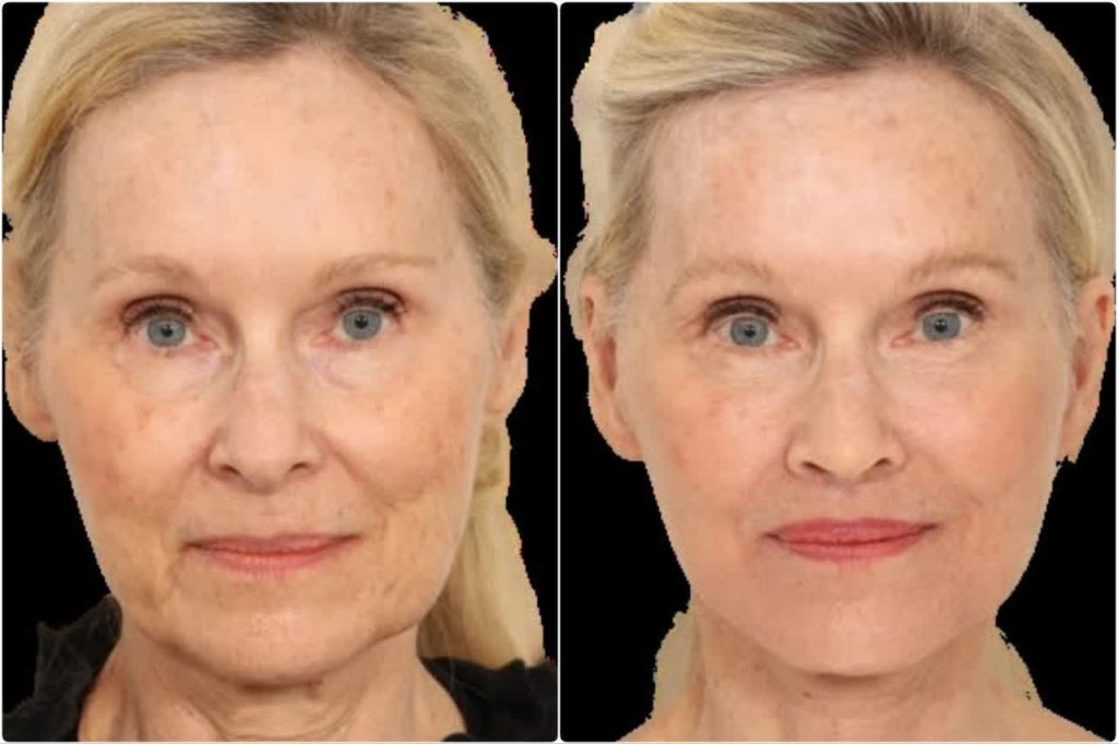 قبل و بعد لیفت صورت 1