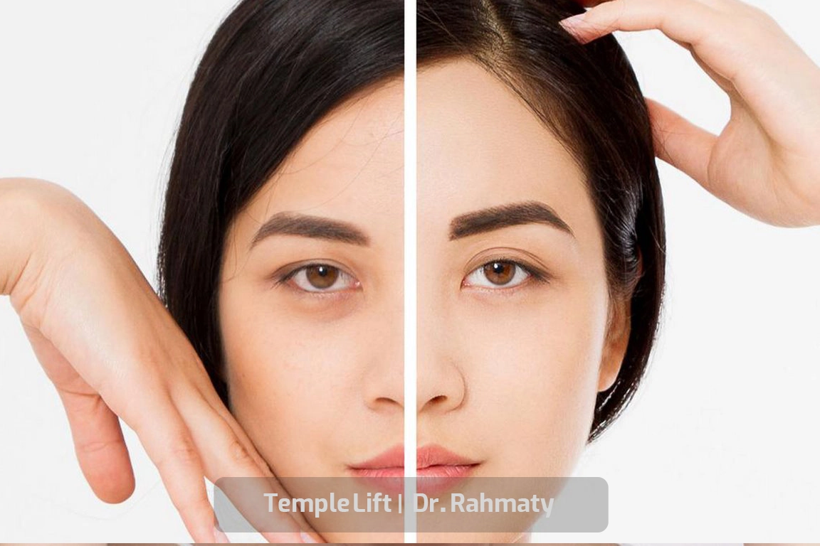 نتایج لیفت شقیقه 3