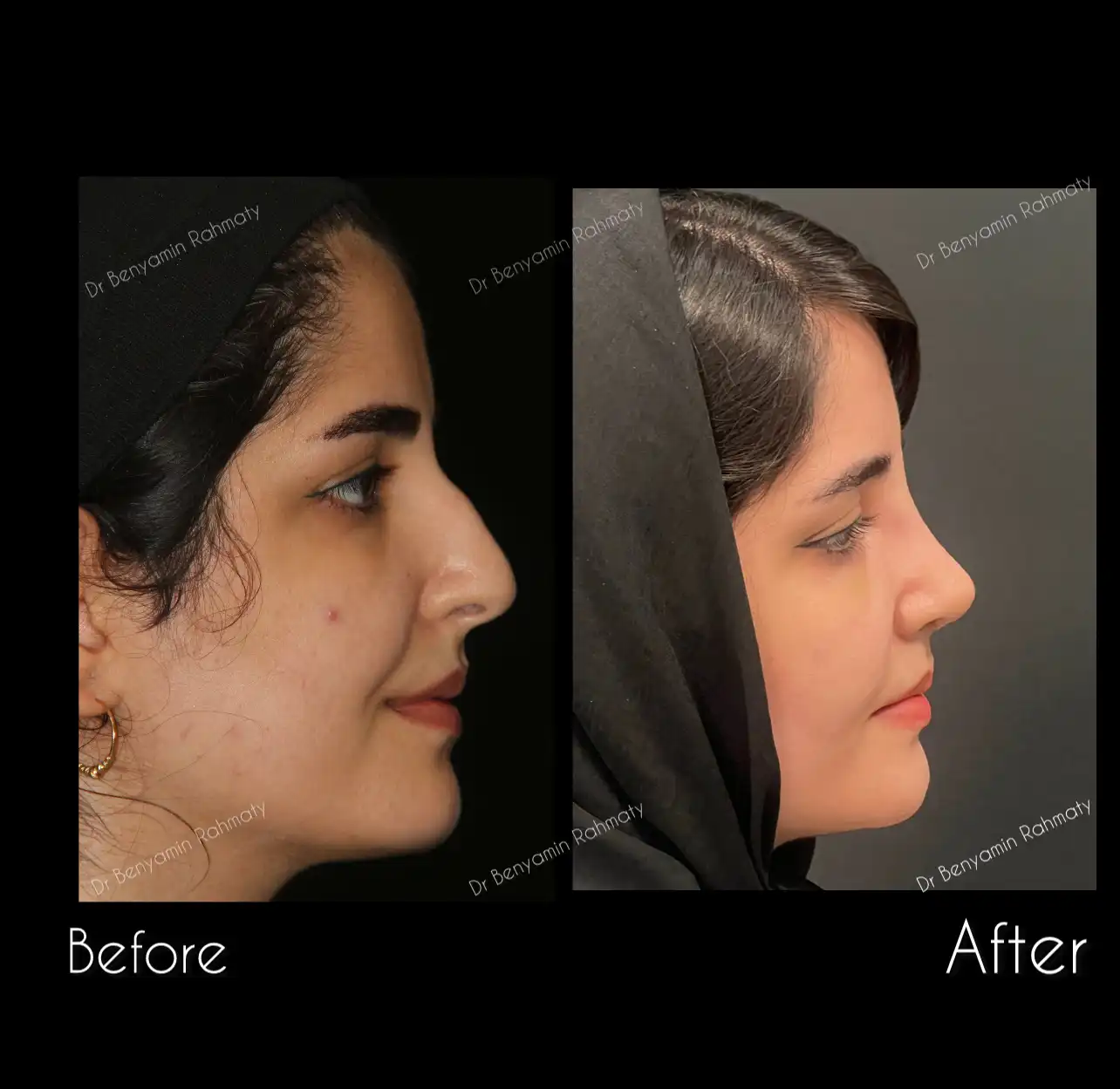 نمونه کار رینوپلاستی دکتر رحمتی