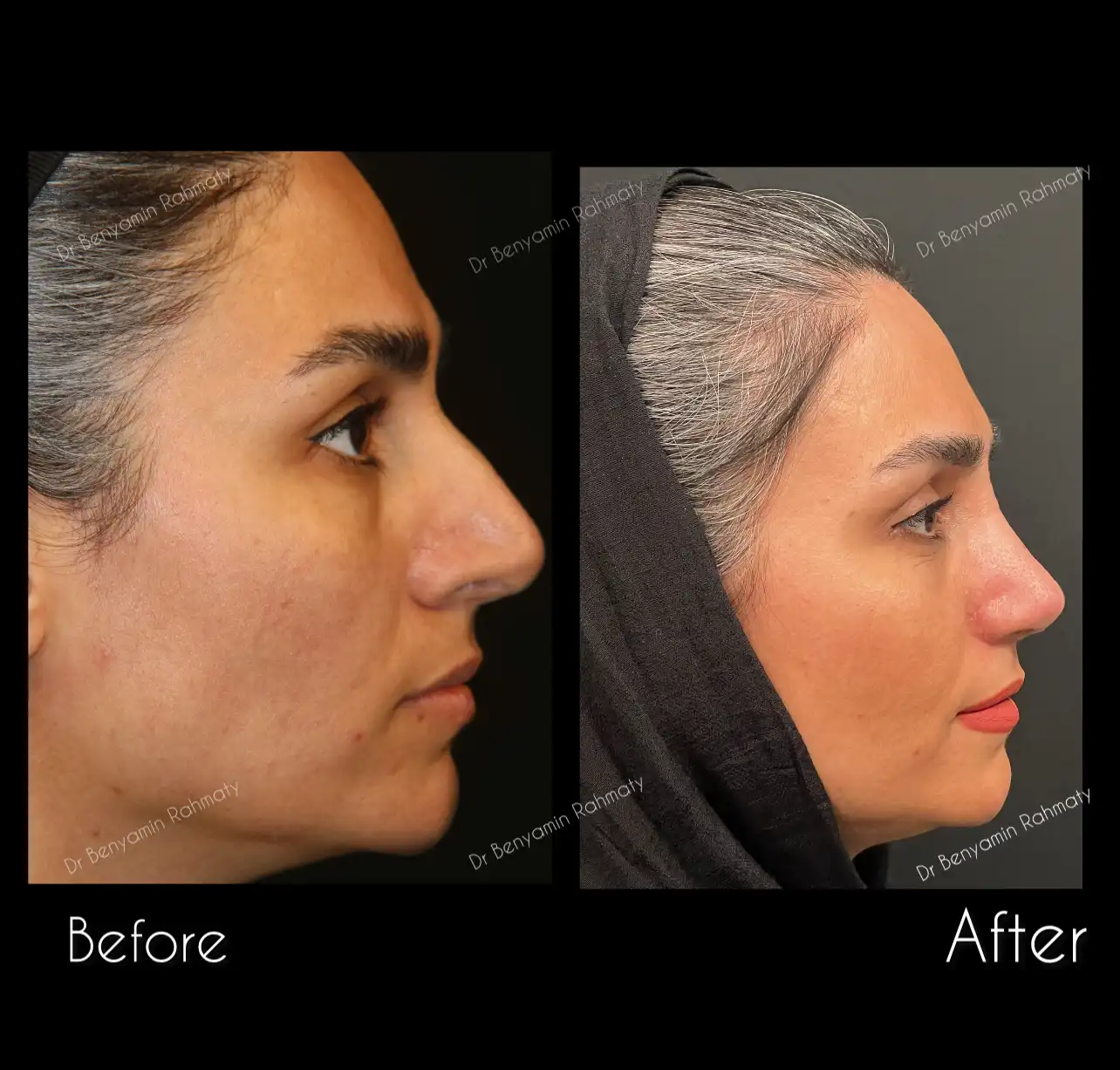 نمونه کار رینوپلاستی دکتر رحمتی 2