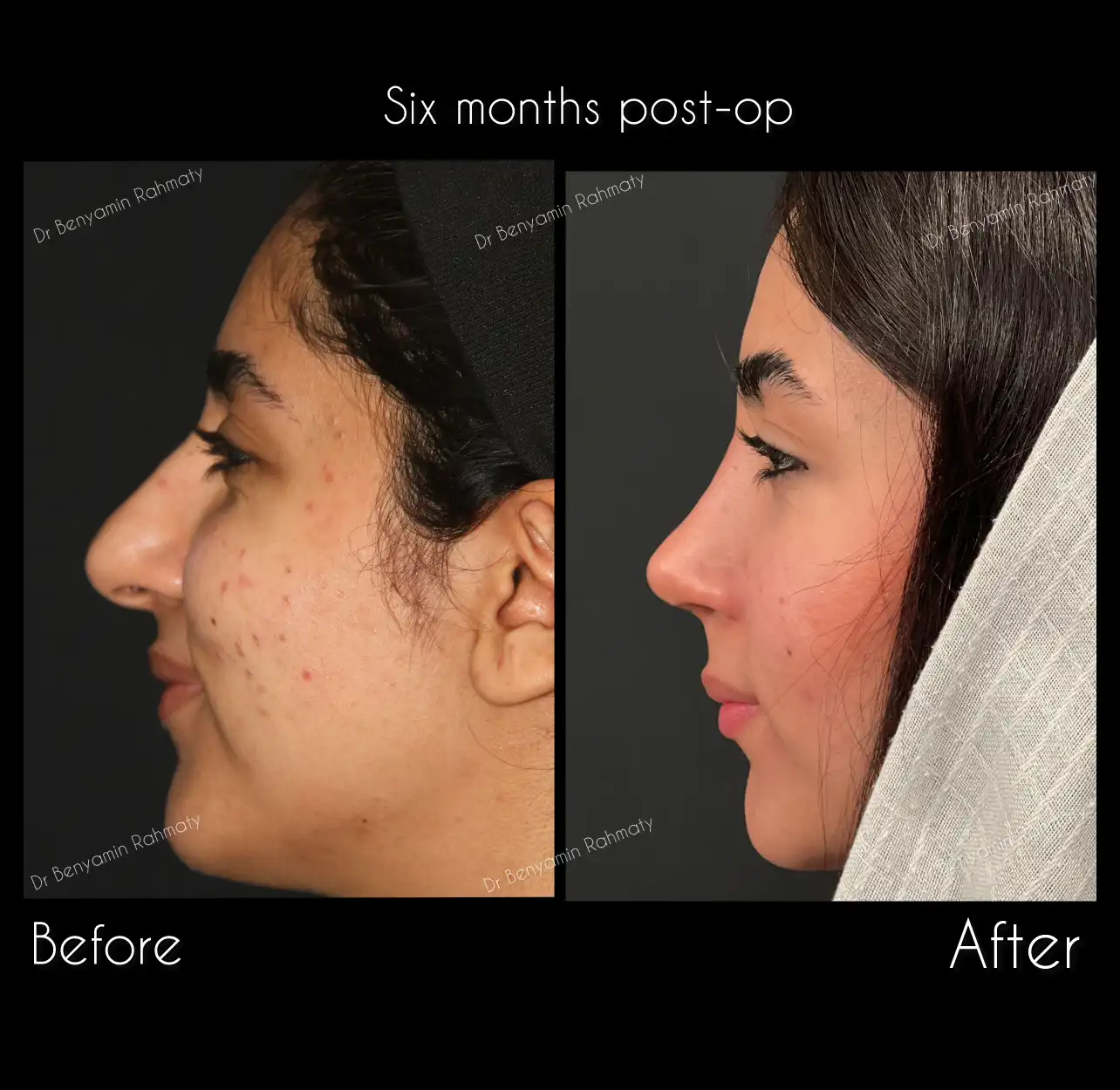 نمونه کار رینوپلاستی دکتر رحمتی 4