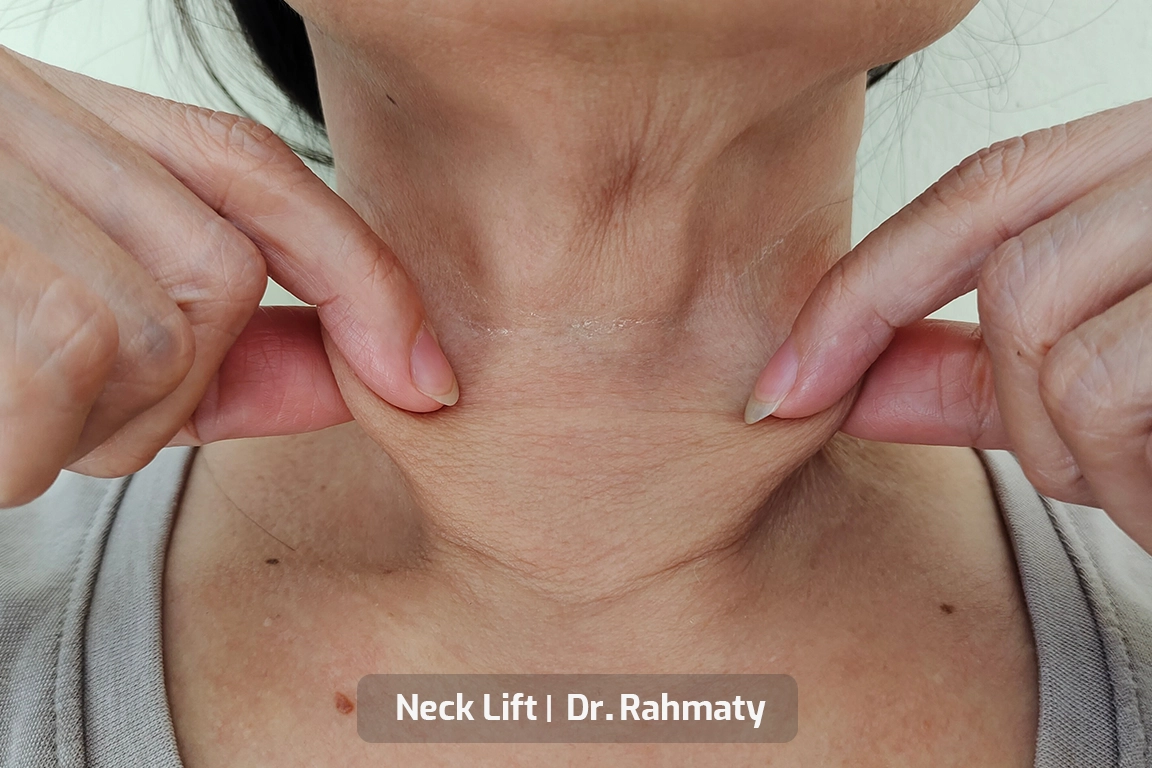 هایفوتراپی غبغب