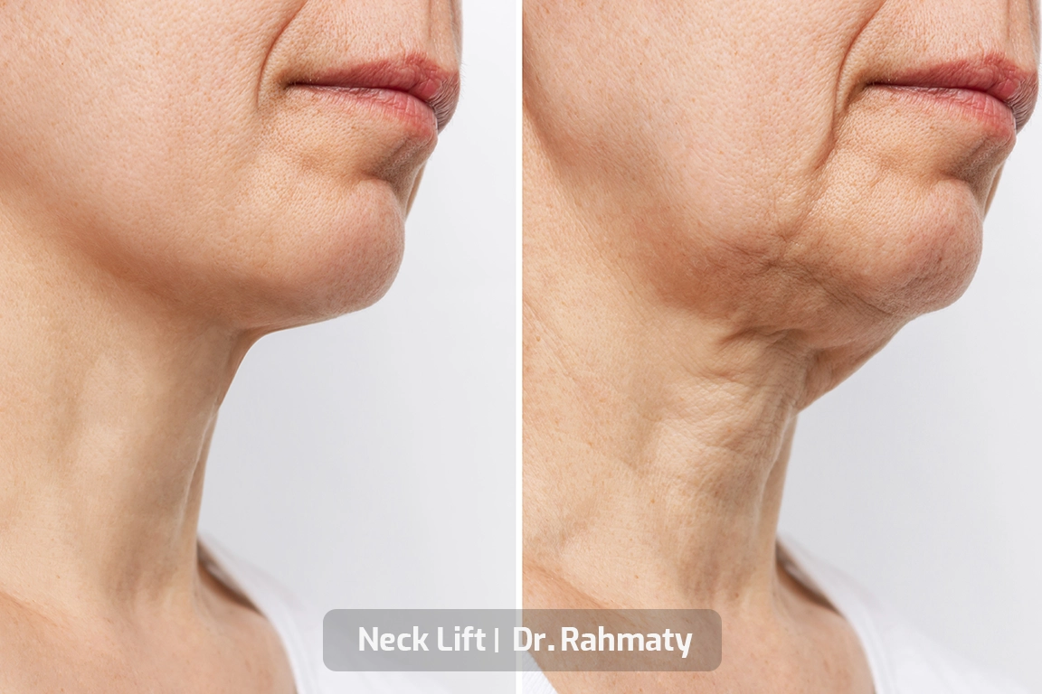 جراحی لیفت گردن 3