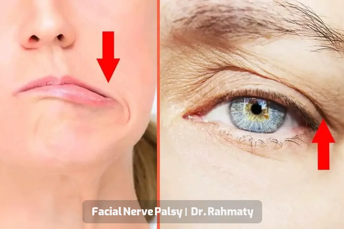 preoperative Facial Reanimation preparation