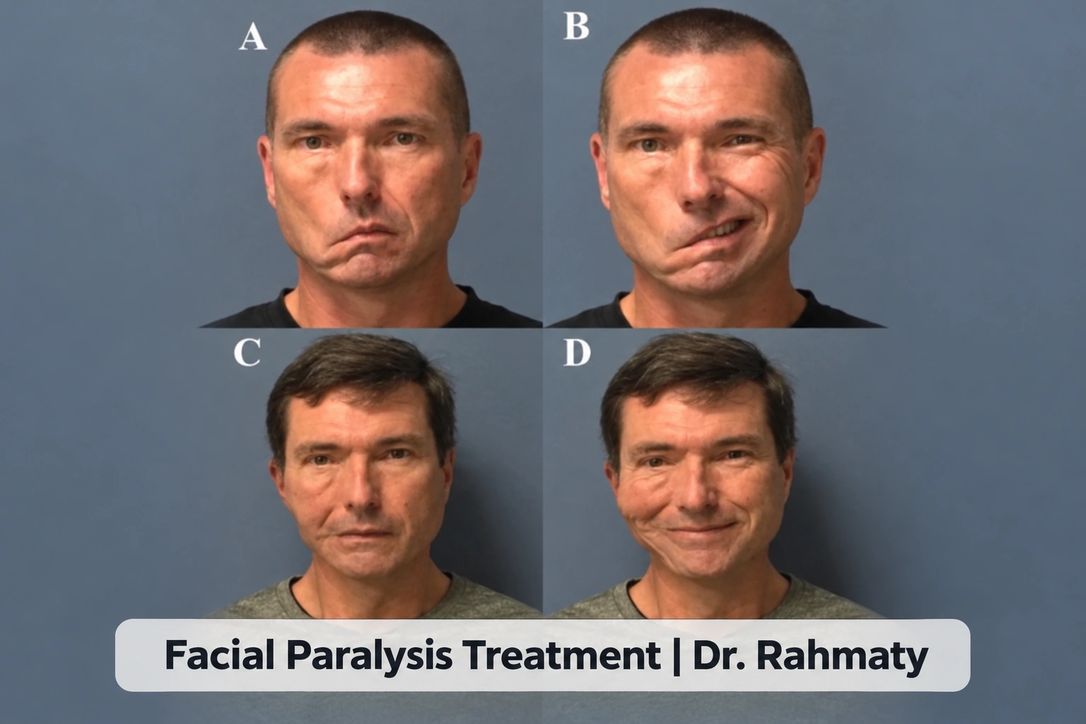 درمان فلج صورت